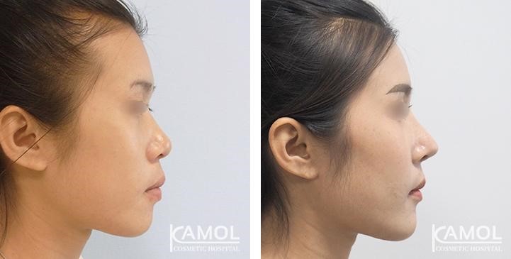 Rhinoplasty_with_e-PTFE