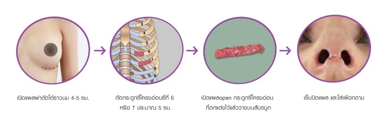 เทคนิคการใช้กระดูกซี่โครงอ่อนมาผ่าตัดเสริมจมูกและผ่าตัด