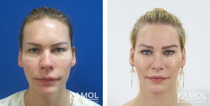 Before_and_After_1_year_surgery,_FFS,_Rhinoplasty,_Jaw Reduction,_Forehead_Compression,_Hairline_Lowering, Hair Transplant, Face Lift, Cheekbone Reduction