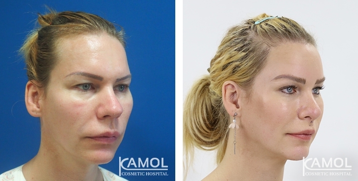 Before_and_After_1_year_surgery,_FFS,_Rhinoplasty,_Jaw Reduction,_Forehead_Compression,_Hairline_Lowering, Hair Transplant, Face Lift, Cheekbone Reduction