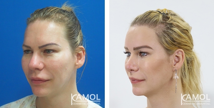 Before_and_After_1_year_surgery,_FFS,_Rhinoplasty,_Jaw Reduction,_Forehead_Compression,_Hairline_Lowering, Hair Transplant, Face Lift, Cheekbone Reduction