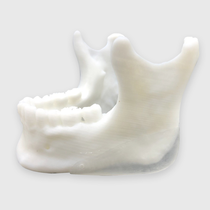 Cuztomized_Jaw_Implant1