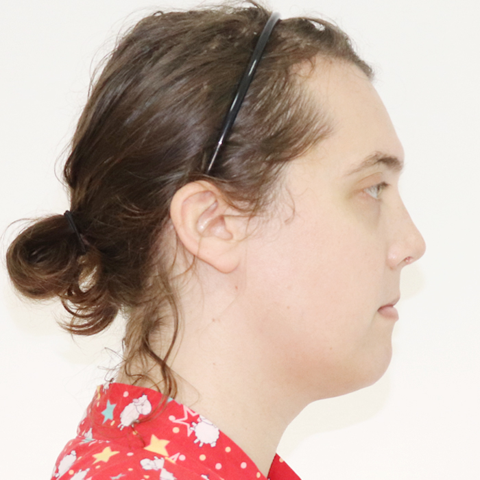 Forehead_Contouring_Type_III