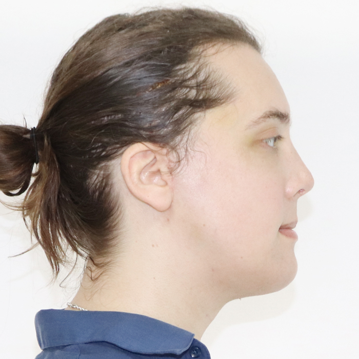 Forehead_Contouring_Type_III