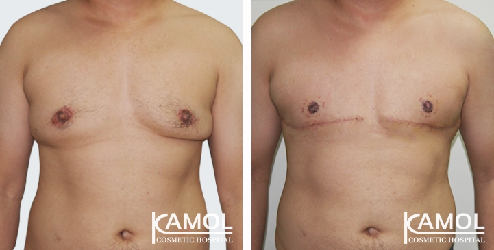 before-after_gynecomastia