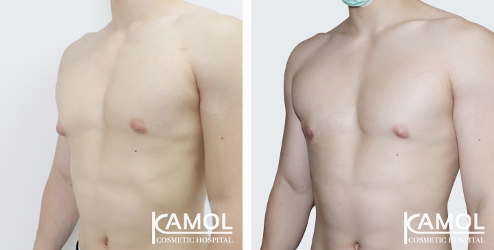 before-after_gynecomastia