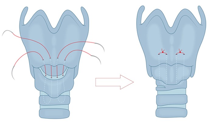 Cricothyroid_approximation_surgery_techniques
