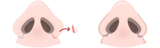 Alarplasty_by_reducing_alar_flap