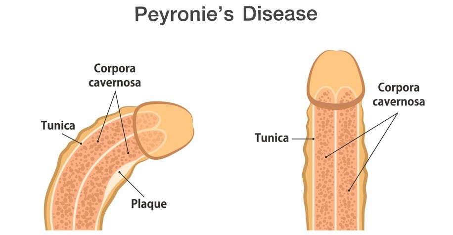 peyronie_disease