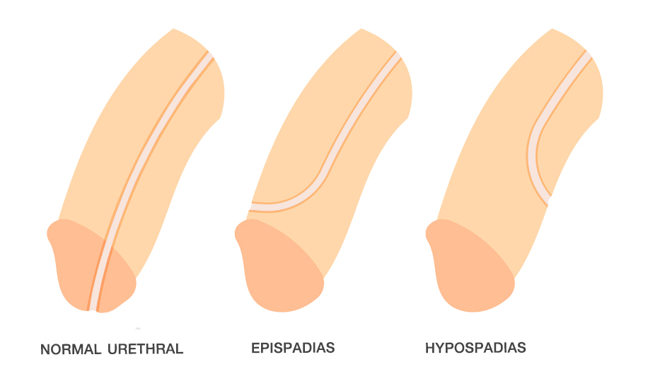 ภาวะรูเปิดท่อปัสสาวะผิดปกติ_(Hypospadies)_โรงพยาบาลศัลยกรรมตกแต่งกมล