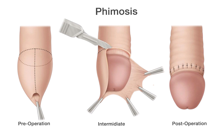 ภาวะหนังหุ้มปลายรัดอวัยวะเพศ_(Phimosis)