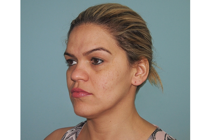 Facial contouring