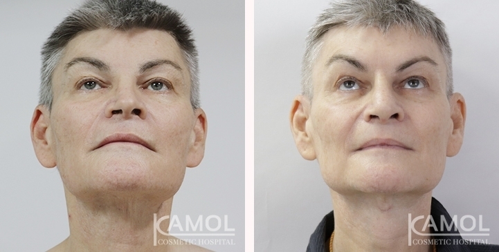Before & After Masculin Nose