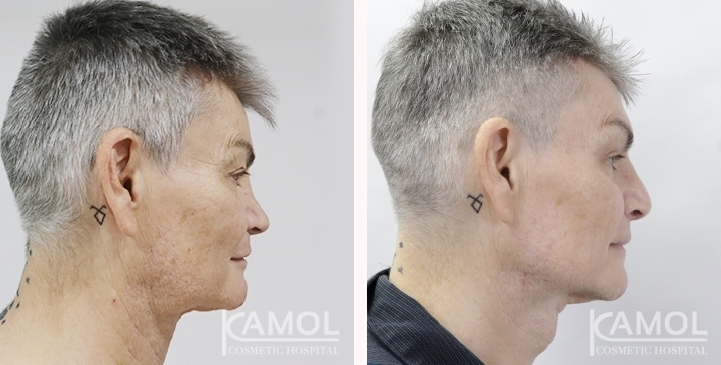 Before & After Masculin Nose