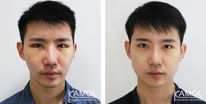 รูปก่อนและหลังการผ่าตัดเสริมกราม