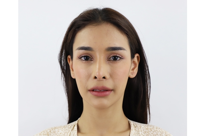รีวิวการเสริมหน้าผาก