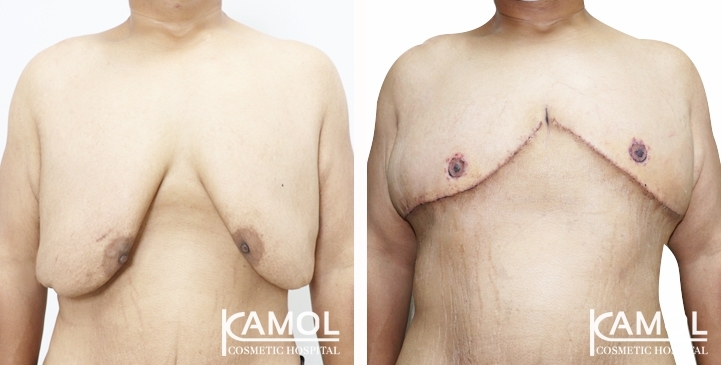 Before & After Gynecomastia