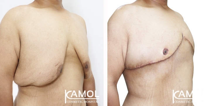 Before & After Gynecomastia