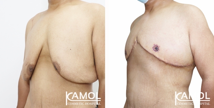 Before & After Gynecomastia