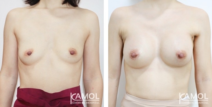 Before and After Breast Augmentation / Breast Implant Surgery