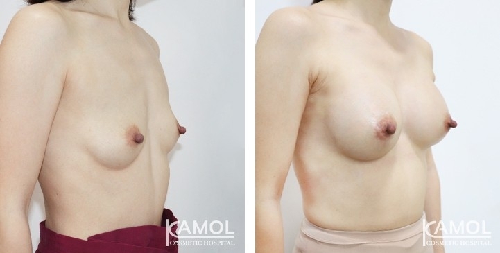 Before and After Breast Augmentation / Breast Implant Surgery