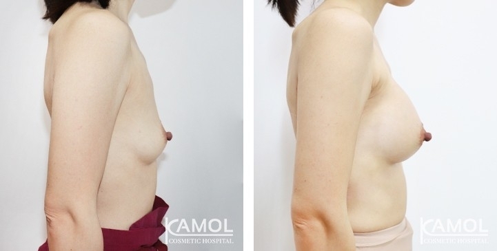 Before and After Breast Augmentation / Breast Implant Surgery
