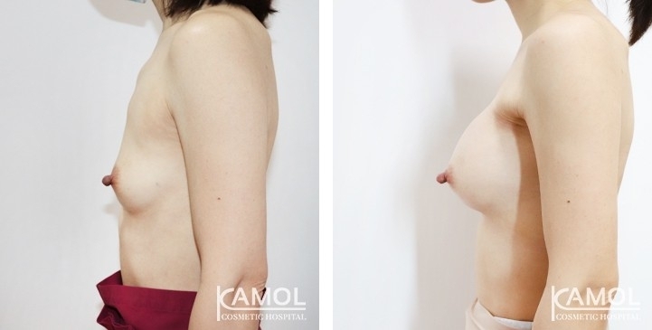 Before and After Breast Augmentation / Breast Implant Surgery