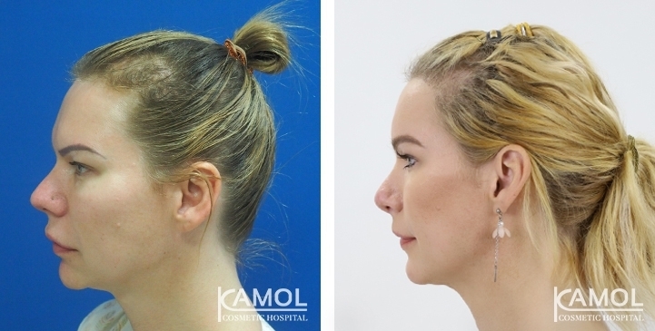 Avant & Après Chirurgie du visage / Remodelage du visage