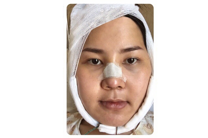 Avis Chirurgie de réduction de la mâchoire, Rasage de la mâchoire 