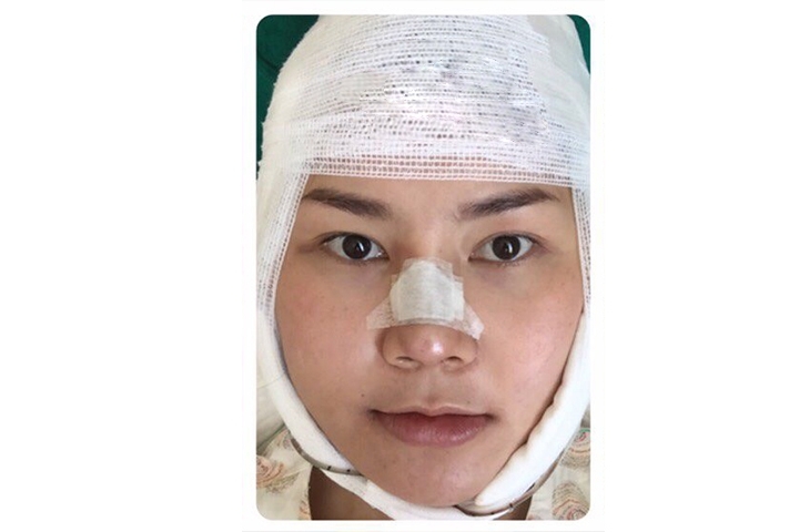 Avis Chirurgie de réduction de la mâchoire, Rasage de la mâchoire 