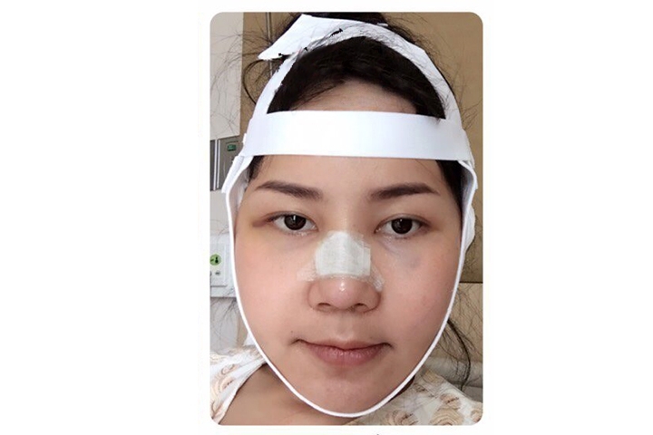 Avis Chirurgie de réduction de la mâchoire, Rasage de la mâchoire 