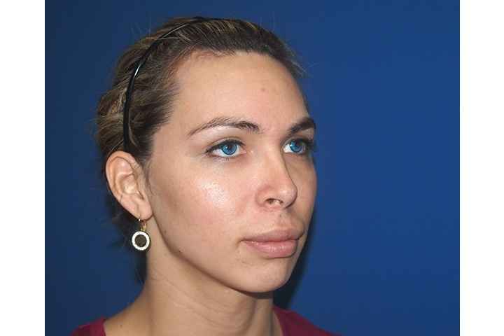 Avis Remodelage du front, modelage des sourcils, réduction des sourcils