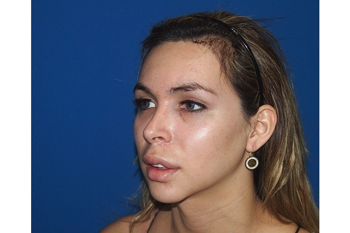Avis Remodelage du front, modelage des sourcils, réduction des sourcils