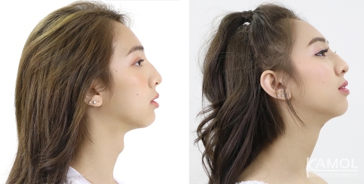 Before and After Tracheal Shave