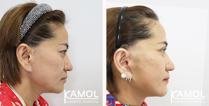 Before & After Facelift / Neck Lift