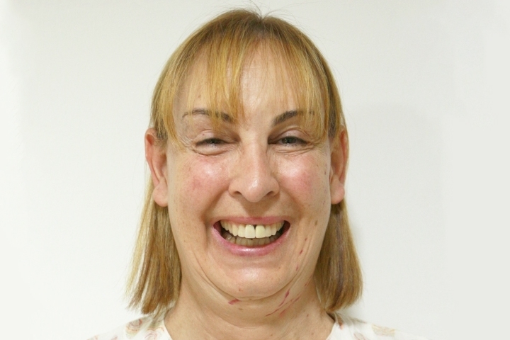 Reviews Facelift Surgery