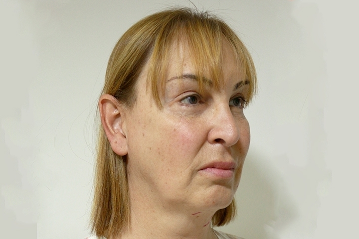Reviews Facelift Surgery