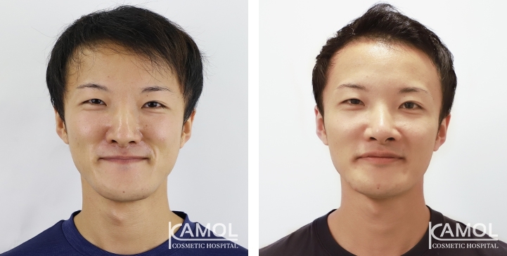 Before & After Corrective Jaw Surgery