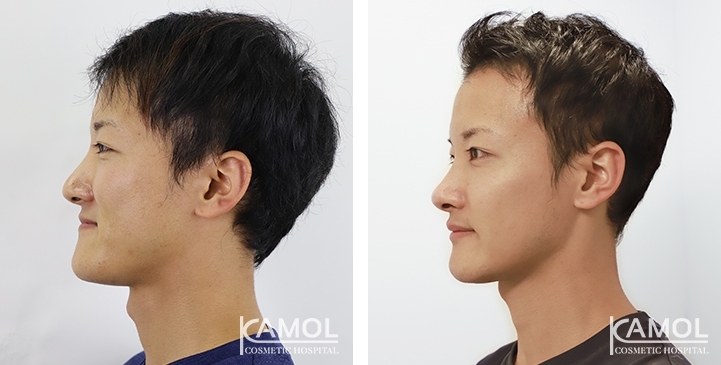 Before & After Corrective Jaw Surgery