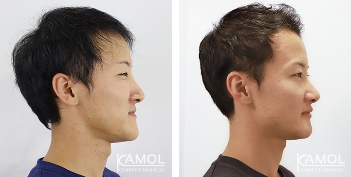 Before & After Corrective Jaw Surgery