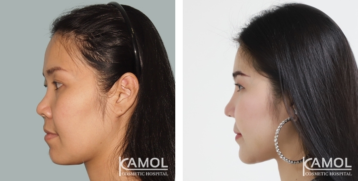 Before & After Jaw Reduction Surgery / Jaw Shaving
