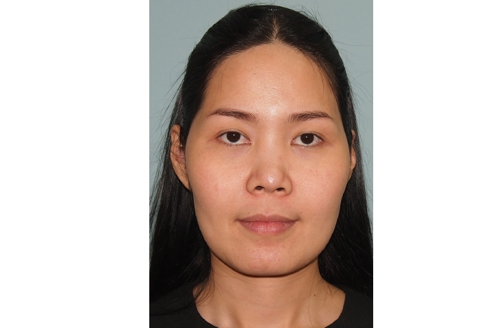Reviews Jaw Reduction Surgery, Jaw shaving