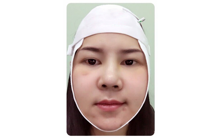 Reviews Jaw Reduction Surgery, Jaw shaving