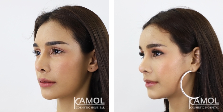 Before & After Forehead Augmentation