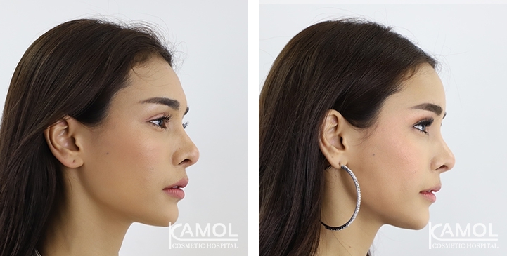 Before & After Forehead Augmentation