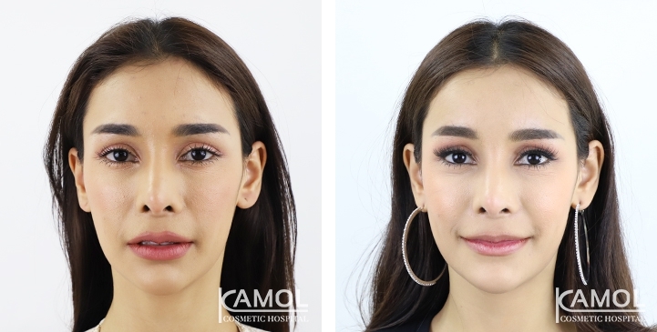Before & After Forehead Augmentation