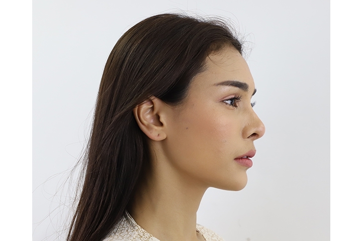 Reviews for Forehead Augmentation