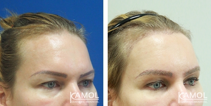 Before & After for Hairline Lowering Surgery / Scalp Advancement / Forehead Reduction