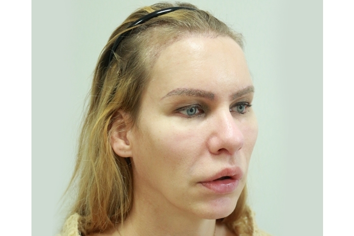 Reviews Hairline Lowering Surgery / Scalp Advancement / Forehead Reduction