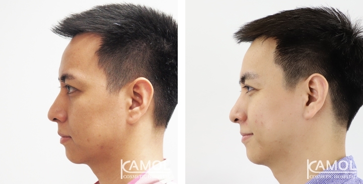 Before & After Forehead Lift / Browlift / Temporal Lift